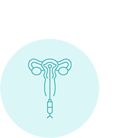 Intrauterine insemination (IUI)